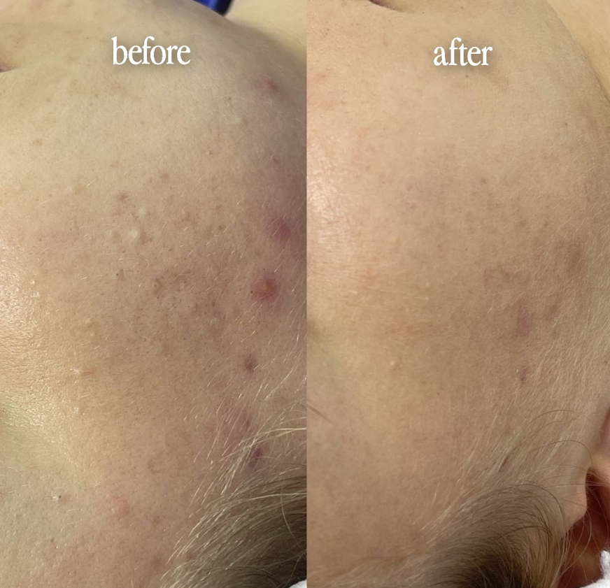 Deep Cleansing Facial treatment for clogged pores and oily skin on patient in dubai inskin clinic