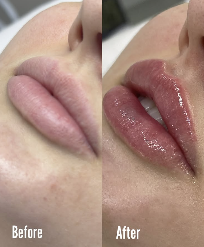 Lip Augmentation and Lip Filler on patient in dubai inskin aesthetic clinic