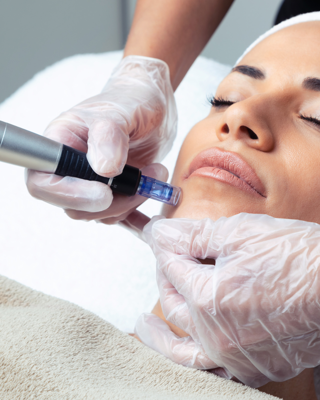 Clinician performing Dermapen microneedling on patient in dubai.