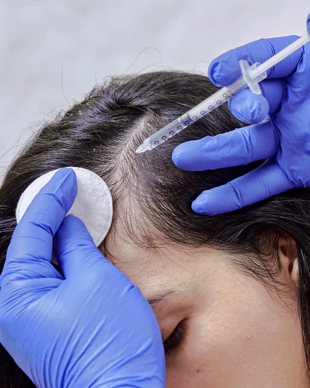 Hair Loss, Hair Fall reduction booster treatment in dubai.