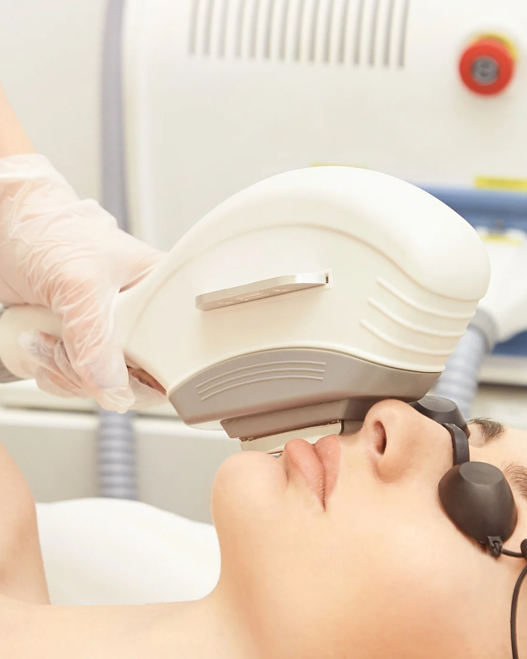 IPL Phototherapy treatment on patient in dubai for Skin pigmentation, rosacea and uneven tone.