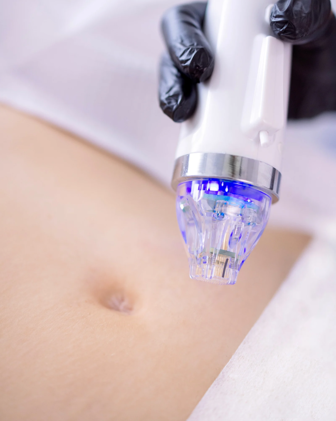 RF Microneedling in dubai for skin tightening on body areas.